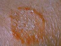 Fotografía de tiña sobre la piel