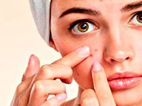 Fotografía de una mujer señalando una espinilla o barro en la cara